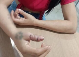Mulher é espancada pelo companheiro e leva facada no dedo que deixa osso exposto