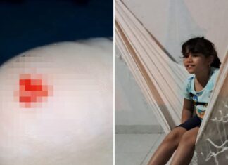 Criança é atacada por piranha em praia e mãe reclama da falta de manutenção das telas de proteção: ‘Está tudo solto’