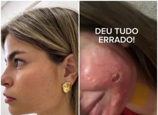 Médica sofre queimaduras graves no rosto após peeling e terá que usar máscara por seis meses: ‘Resultados eram falsos’