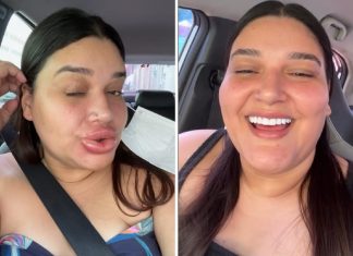 Maquiadora que ficou com lábios gigantes conta que preenchimento deu errado: ‘Estavam tortos’