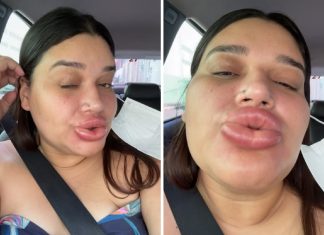 Maquiadora fica com lábios gigantes após retirar preenchimento labial e viraliza ao rir da situação: ‘Lindíssima’