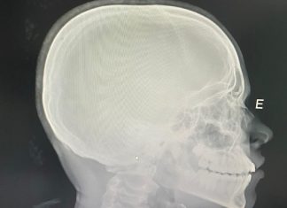 Estudante tem nariz quebrado após sofrer ofensas racistas e agressão em escola pública do Tocantins